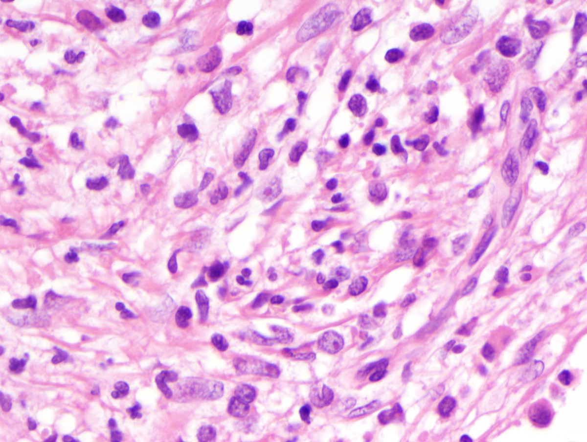 E) Bone marrow cellularity composed of fibroblasts, scattered immature mononuclear cells and decreased megakaryocytes (H&E, oil 1000x)